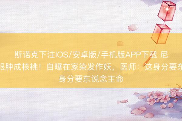 斯诺克下注IOS/安卓版/手机版APP下载 尼格买提右眼肿成核桃!自曝在家染发作妖,医师:这身分要东说念主命